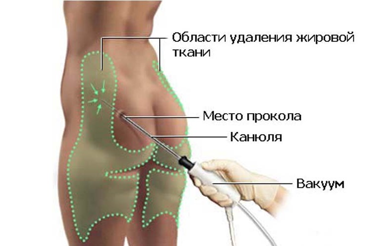 области удаления жировой ткани при липомоделировании