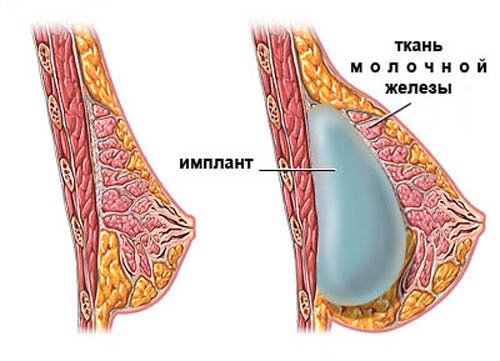 расположение импланта в женской груди