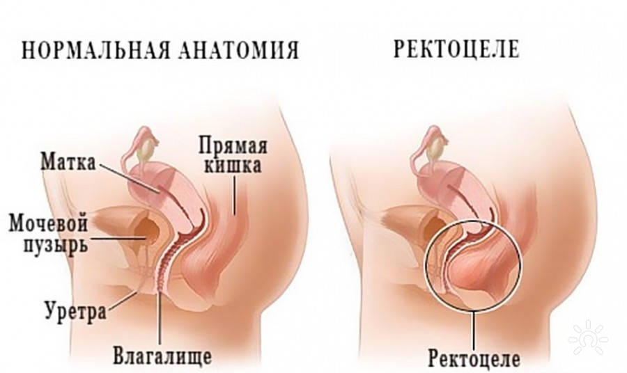 нормальная анатомия женского таза