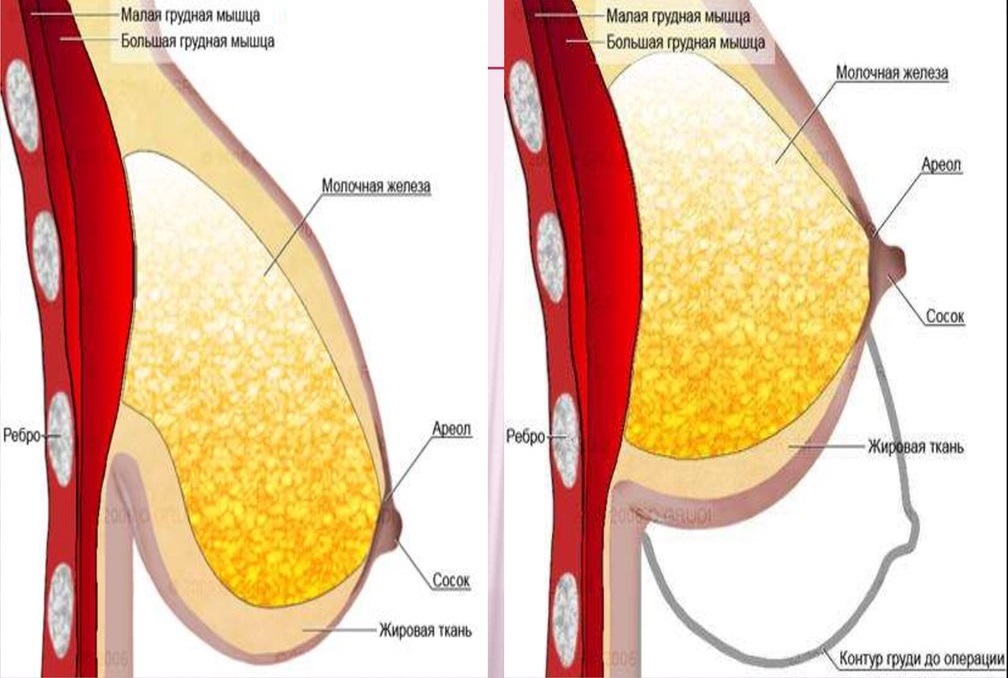 схема контура груди до и после мастопексии