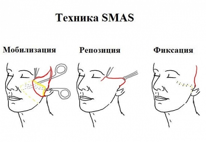 схема проведения СМАС-подтяжки
