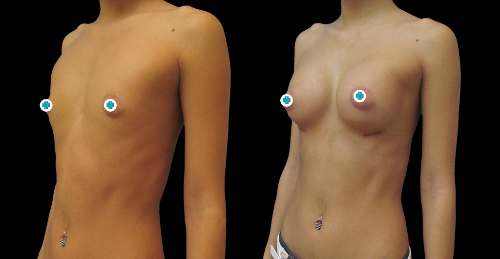 фото до и после увеличения груди