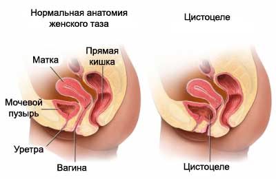 нормальная анатомия женского таза