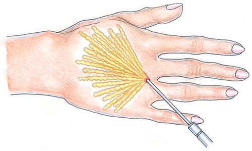 схема проведения липофилинга кистей рук