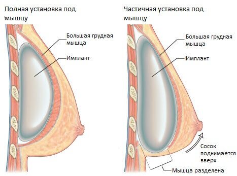 полная и частичная установка импланта под мышцу груди